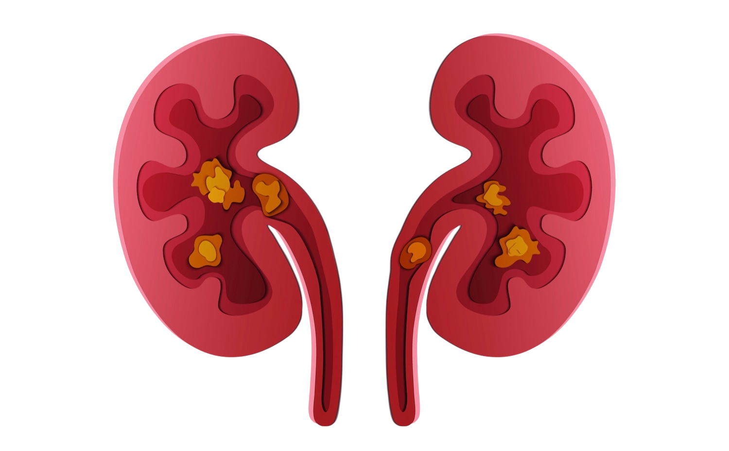 Tulane Kidney Stone